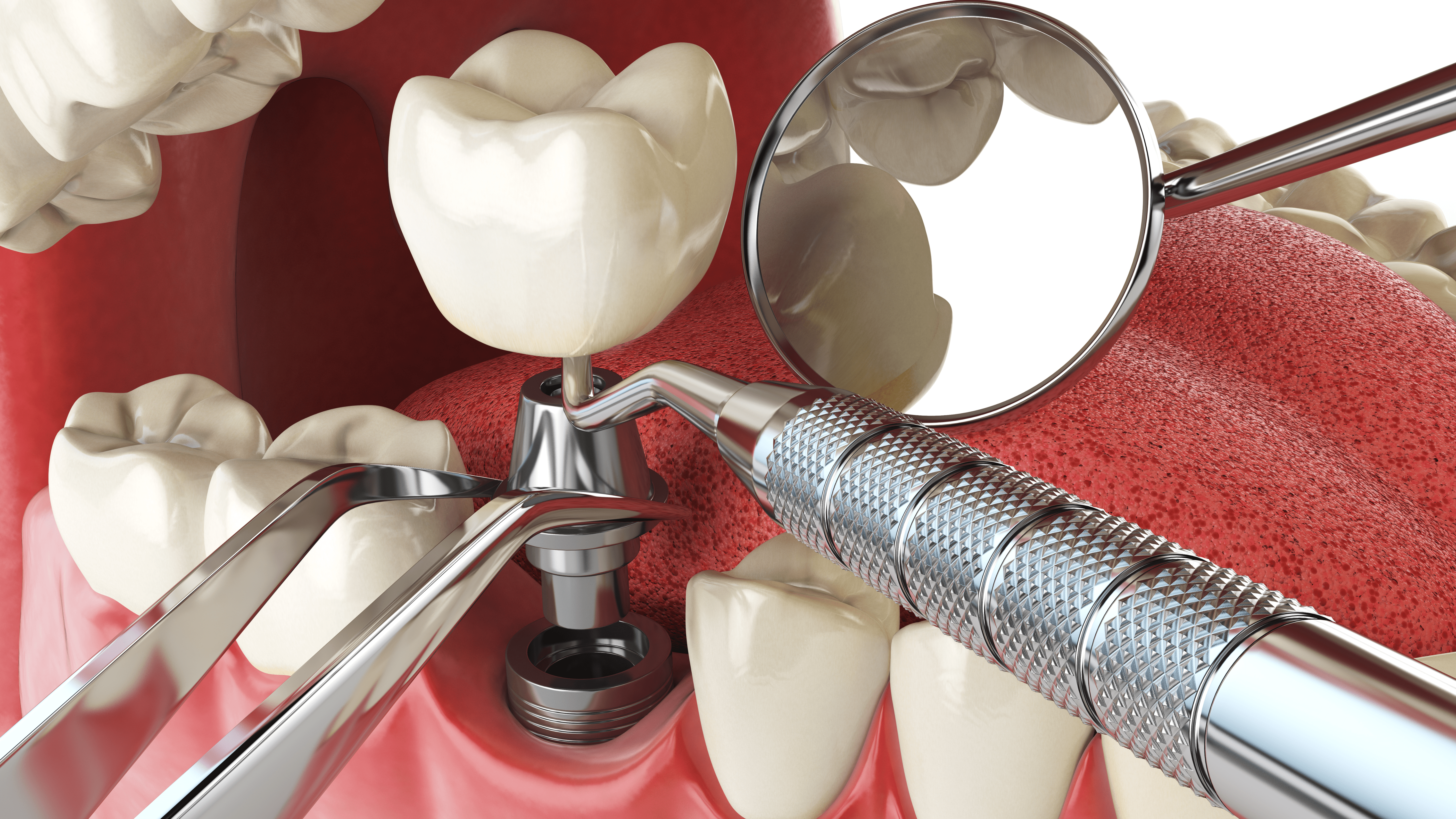 Cuma 5-10 menit tapi dapat mengembalikan senyum indah?! - Mengenal Dental Implant.